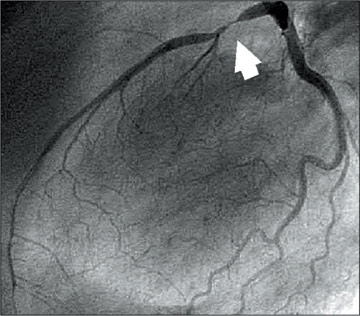 Herz - R&ouml;ntgenaufnahme