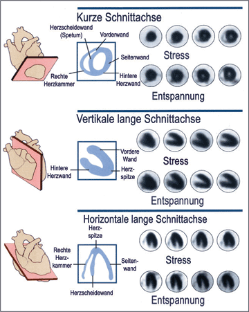 Myokardszintigraphie - Entstehung sichtbarer Schnitte
