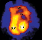 RNV-Darstellung der maximal gef&uuml;llten Herzkammern
