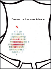 Hei&szlig;er Knoten im rechten Schilddr&uuml;senlappen