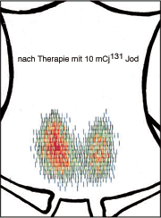 dieselbe Schilddr&uuml;se nach Radioiodtherapie