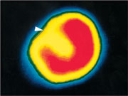 Szintigramm des Herzens in Belastung