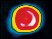 Szintigramm des Herzens in Ruhe