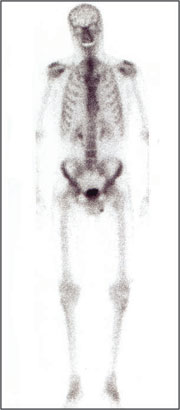 gesundes Skelettszintigramm
