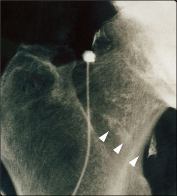R&ouml;ntgenbild H&uuml;ftgelenk