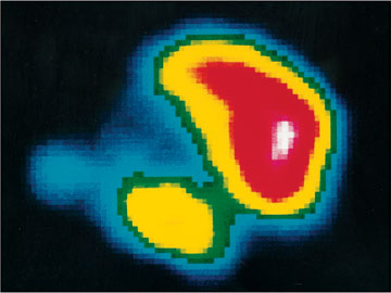 Szintigramm H&uuml;ftgelenk