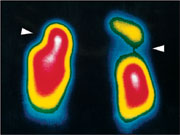 Durchblutungsszintigraphie Lunge