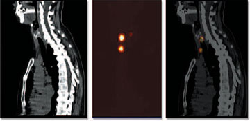 Fusion (PET/CT, rechts)